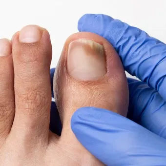 Fisioterapia podológica — Hongos en Valencia