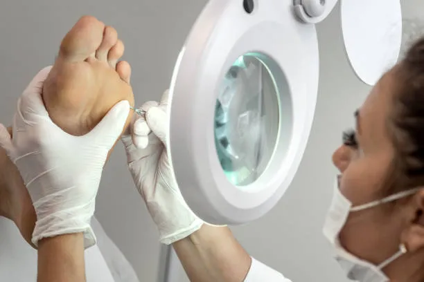 Fisioterapia podológica — Verrugas en Valencia